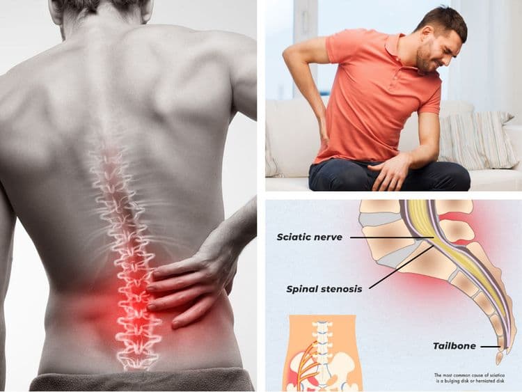 Sciatica and lower back pain care — Nektalov Chiropractic & Wellness, Forest Hills Queens NY